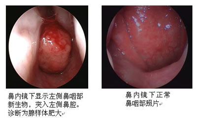 上呼吸道阻塞性疾病与睡眠障碍