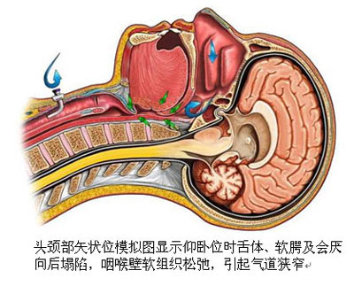 上呼吸道阻塞性疾病与睡眠障碍