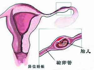 宫外孕的临床表现如下: 1、宫外孕常表现为阴道不规则出...
