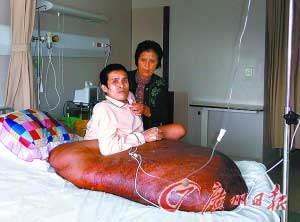 越南男子手术摘90公斤重巨瘤 医生免费开刀(图