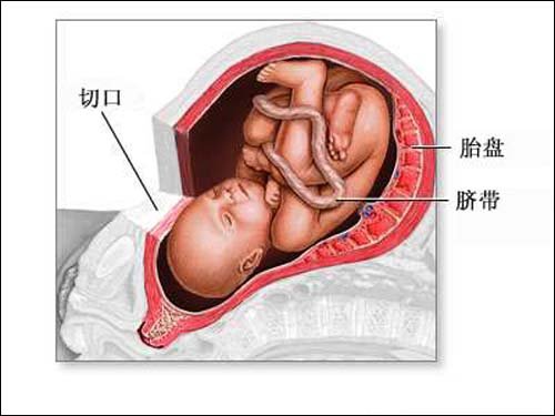 剖腹产手术过程详细图解(组图)