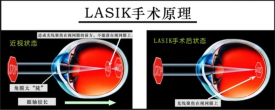 台湾名医宣布停做激光近视矫正手术引发业者争