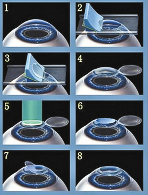 患者毁誉参半 激光治近视到底安不安全?(组图)-搜狐滚动