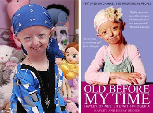　14岁女孩海莉患上罕见早衰症，身体年龄已有105岁。但她乐观坚强，已出版了自传《未年轻便老去》。 