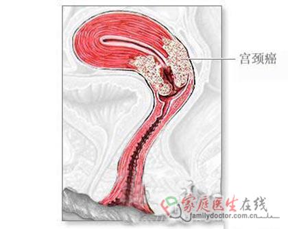 消毒宫颈;麻痹宫颈管(非常规性);用一支棒状宫颈扩张器扩张宫颈;用