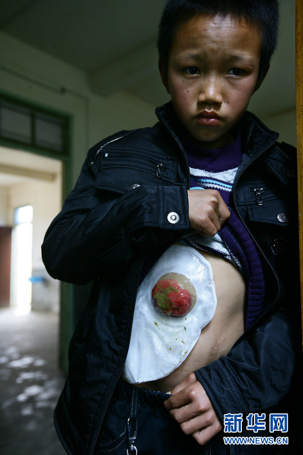 先天性无肛门男孩靠腹部造瘘口排便 盼回课堂(组图)