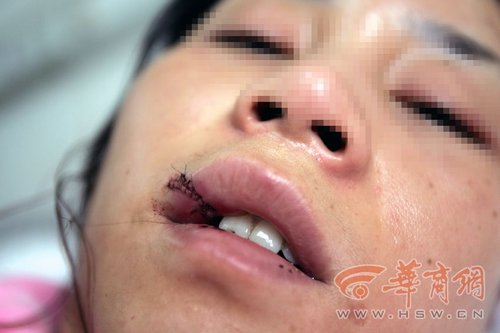 姜苗苗的嘴巴被打烂,缝了20多针,牙齿也被打掉了两颗.