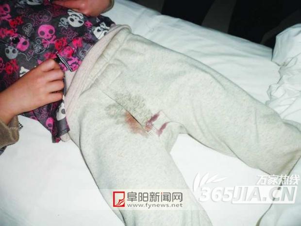 阜阳一5岁男童被教师踢伤下体包皮开裂被缝6