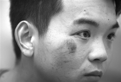 昨日，送餐员小赵因剐蹭，受凯迪拉克车上4人殴打，右眼眼球充血，眼睑还呈紫色，在家中休养。本报记者 王贵彬 摄