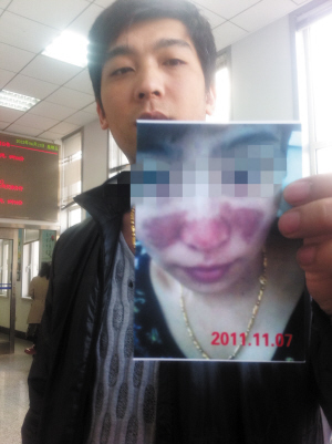 花8888元整容变"毁"容 女子脸上溃烂结痂(图)