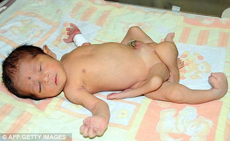 巴基斯坦一名婴儿出生时长了6条腿。