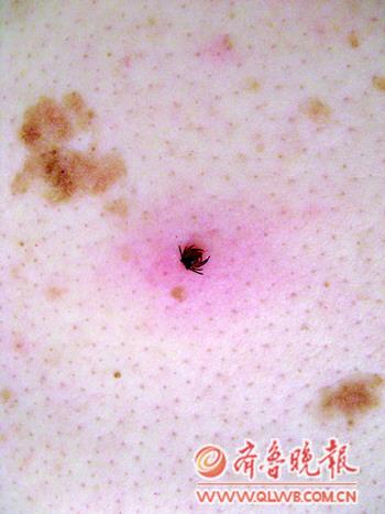从2日至6日,青岛市第八人民医院皮肤科已经接诊了6位蜱虫咬伤患者.