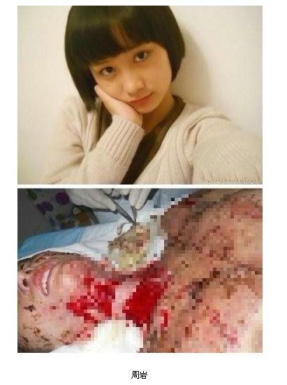 本报讯 合肥少女毁容案受害人周岩代理律师李智贤8日透露,合肥包河