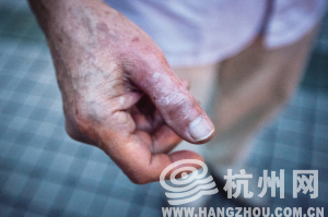 大伯被蜈蚣咬伤的右手拇指涂上了药膏 记者 陈中秋 摄
