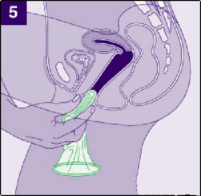 女用避孕套使用方法(组图)