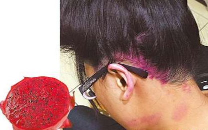 台湾女子染发后头皮变紫红色 形似火龙果(图