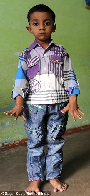 印度4岁男孩长13个手指12个脚趾(1)_科技频道