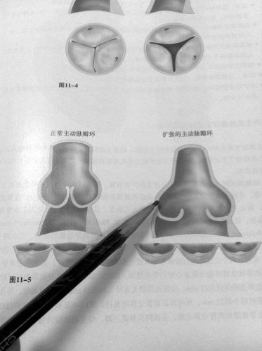 正常的主动脉瓣环(左,患马凡氏综合征的主动脉瓣环(右.