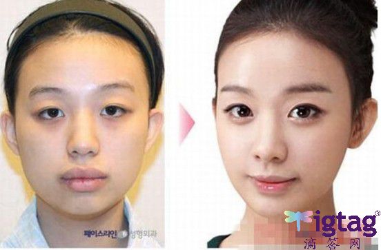 韩国艺人整容照片前后对比
