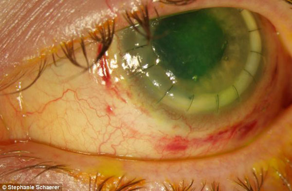 女子戴视康隐形眼镜一天后感染 被迫摘除眼球