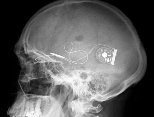 德国图宾根大学科学家发明植入脑内微型芯片 可助盲人重见光明