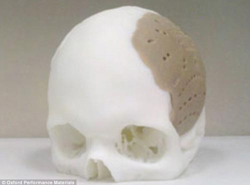 美国一位患者的75%脑颅骨由3D打印模型替代