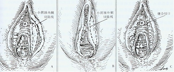 盘点:女性私密部位整形9大项目