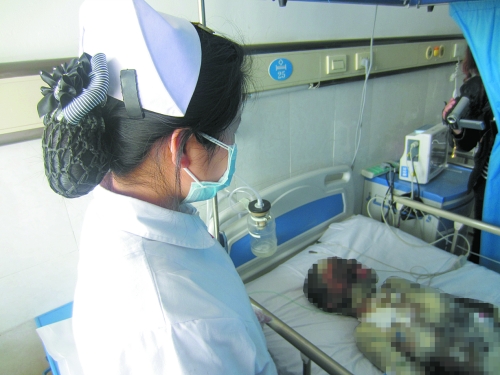 一名护士照看烧伤女孩闫倩玉。