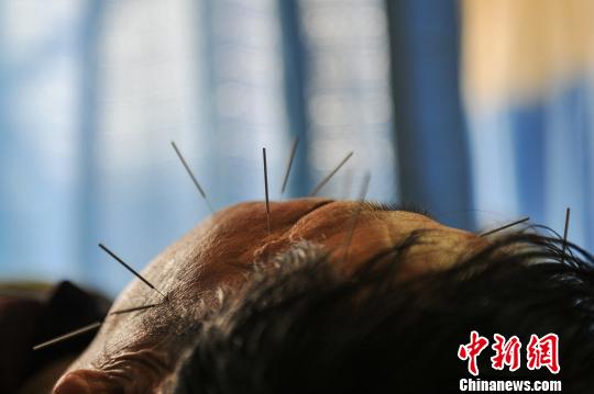 "云南版"h7n9中药方首推针灸疗法(1)_中医频道_光明网(组图)