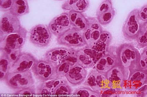 夏威夷发现 超级淋病菌 传染性或超过艾滋病毒
