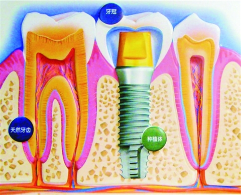 老年人牙齿缺失最好的解决方法---种植牙(图)