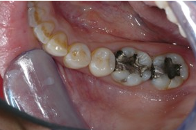 患者因后牙深龋洞一次垫底银汞充填,术后一直冷热痛2周,复诊时叩( )