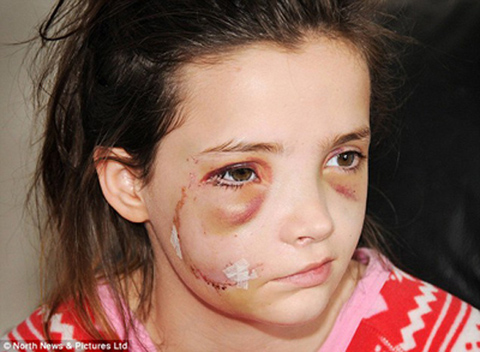 英国13岁少女被德国牧羊犬袭击近乎毁容(图)