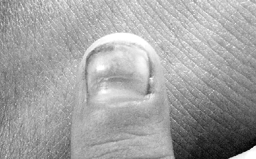 8个孩子的指甲,出现断裂脱落症状