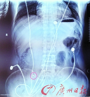 受伤保安施某的ct片,清晰可见有个亮点(医生告知,这个亮点就是枪击后