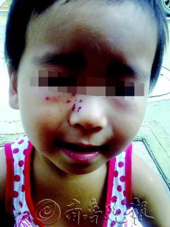 2岁女童幼儿园中受伤 老师称是孩子自己抓的(