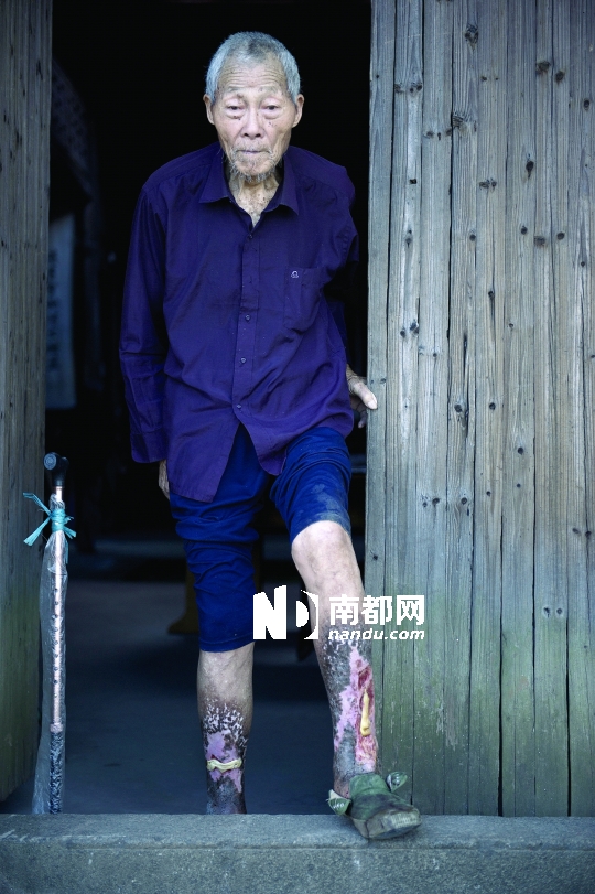 83岁的毛省甫已经时日无多，他被“烂脚病”折磨70多年。