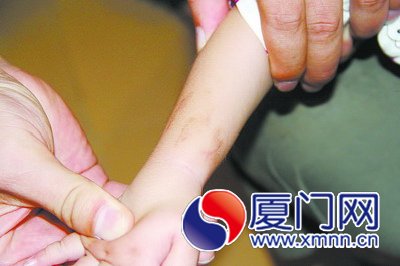 事发后一个星期,凤凤手臂上的咬痕还没消退.