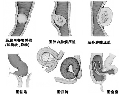 肠梗阻的6个常见病因(图说疾病)