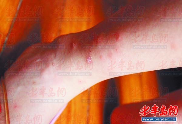 跳蚤组团咬,腿上全是包(图)