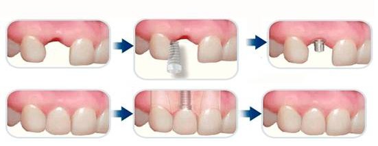拜尔昊城口腔:种植牙的治疗过程(图)