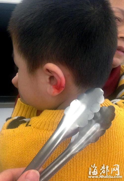 幼儿园男童耳朵受伤流血 称被阿姨用蛋糕夹夹