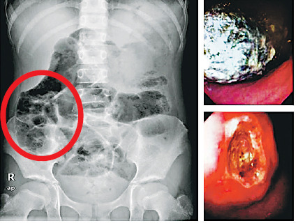  9歲女孩肚痛及嘔吐達3周，照內窺鏡時發現其左邊胃部積聚兩大團頭發（右上圖），長度約有16厘米，引致胃潰瘍。左圖X光片可見該兩大團頭發（紅圈示）。來源：香港《明報》
