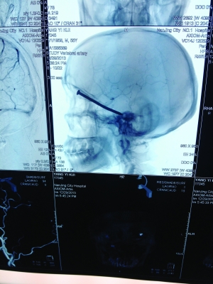 男子被8厘米长钉戳中穿透骨头进入大脑(图)