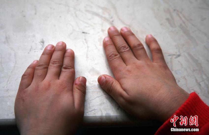 杭州17名儿童指甲断裂脱落 排除污染和真菌感染