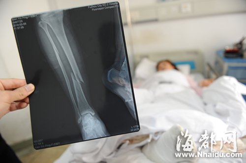 x光片显示,该女士的小腿骨折