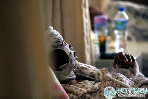 一个被烟花爆竹炸伤的孩子躺在医院里痛苦不堪.记者张玉杰/摄