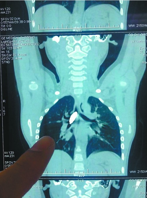 面对惊恐的大人，明明淡定地说，像刘谦那样，磁铁可以变出来；最终医生切开气管才取出   X光片显示，磁铁卡在了明明的气管附近。 儿童医院供图