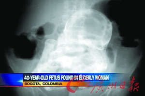 医生替巴西的这名老奶奶照X光后居然在其腹中发现了一个石化的胎儿（电视画面截图）。