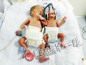双胞胎兄弟出生时，右边的小双仅重650克。
